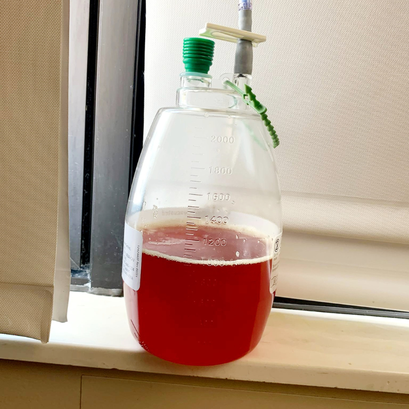 Liter of Fluid Drained from Richie's Lung Today